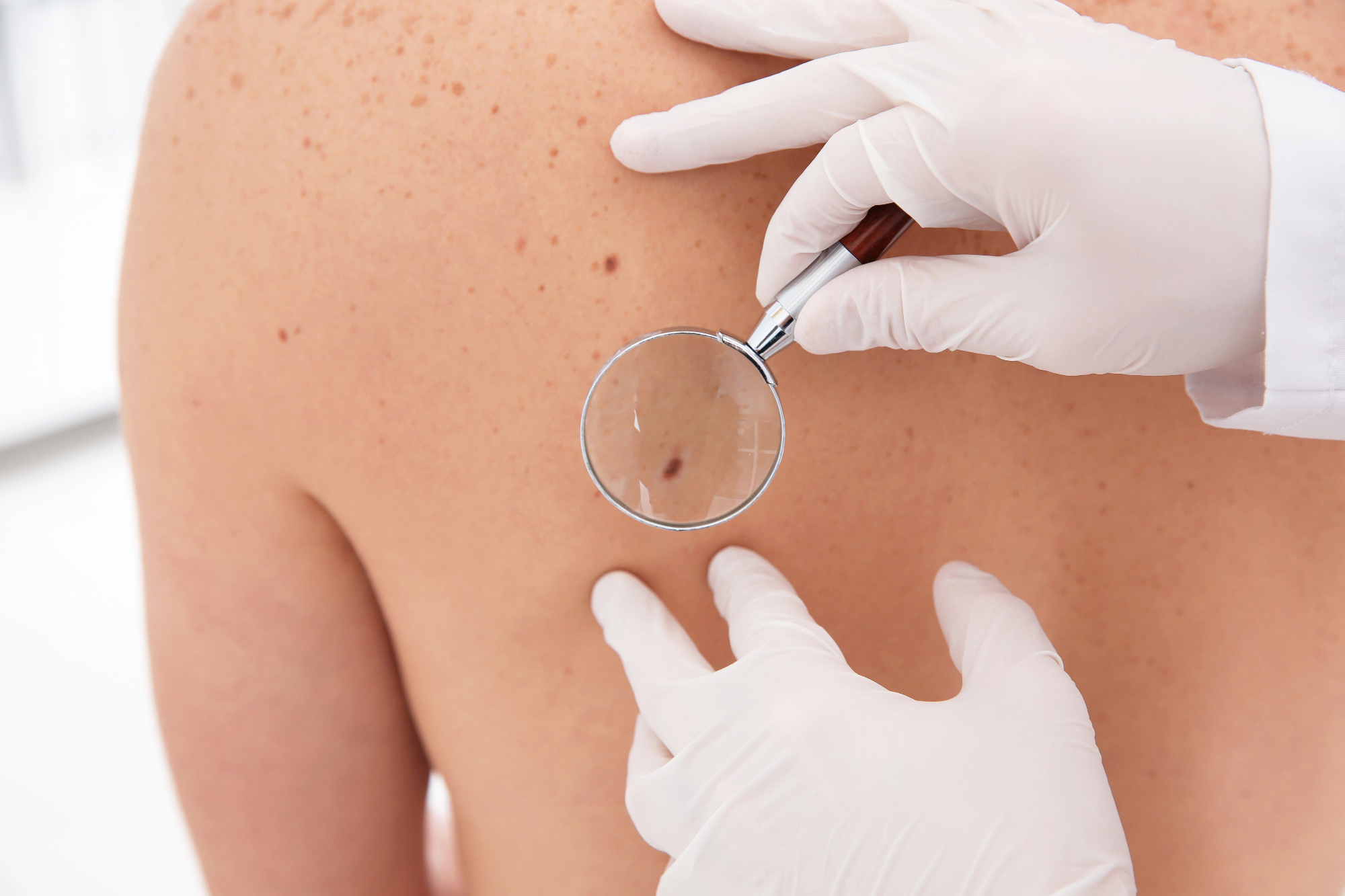 Krema ali dermatolog, kaj izbrati
