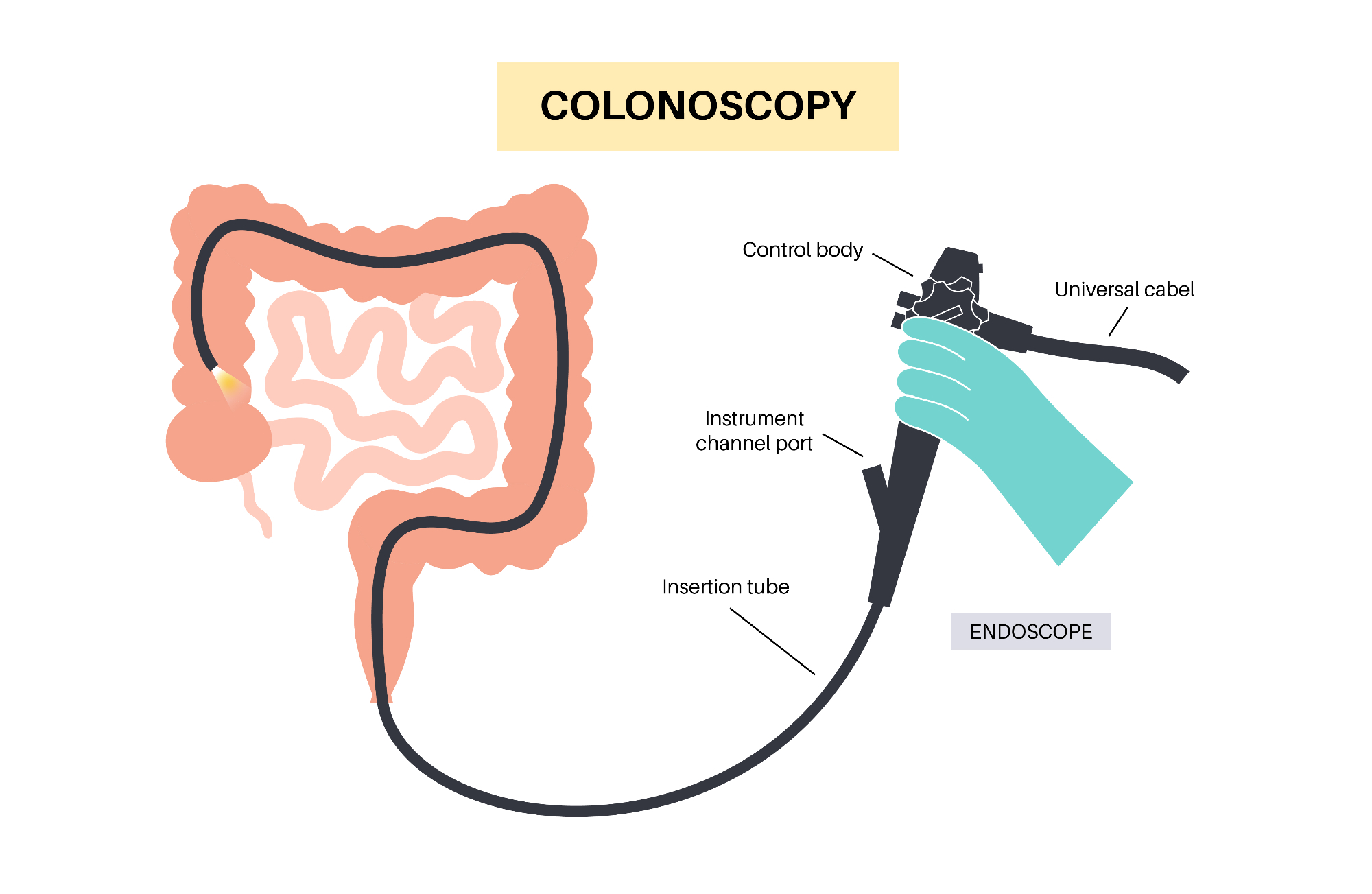 Samoplačniška kolonoskopija so besede, ki jih moja babica ni želela slišati